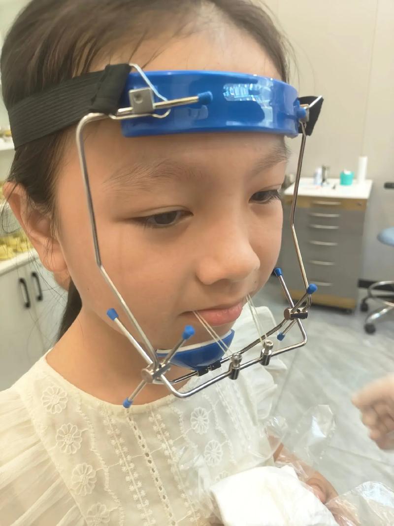 正畸前方牵引器图片展示了哪些佩戴和使用要点？-图3
