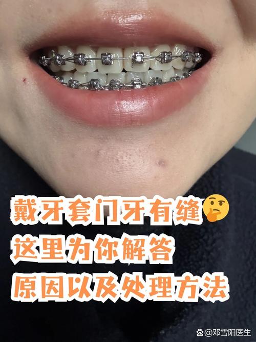 正畸后门牙为何会出现缝隙?-图2 正畸后门牙为何会出现缝隙?-图2