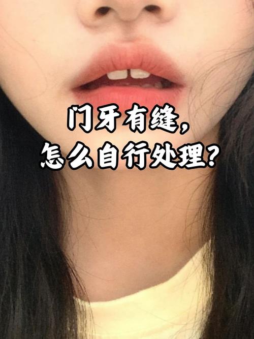 正畸后门牙为何会出现缝隙?-图1 正畸后门牙为何会出现缝隙?-图1