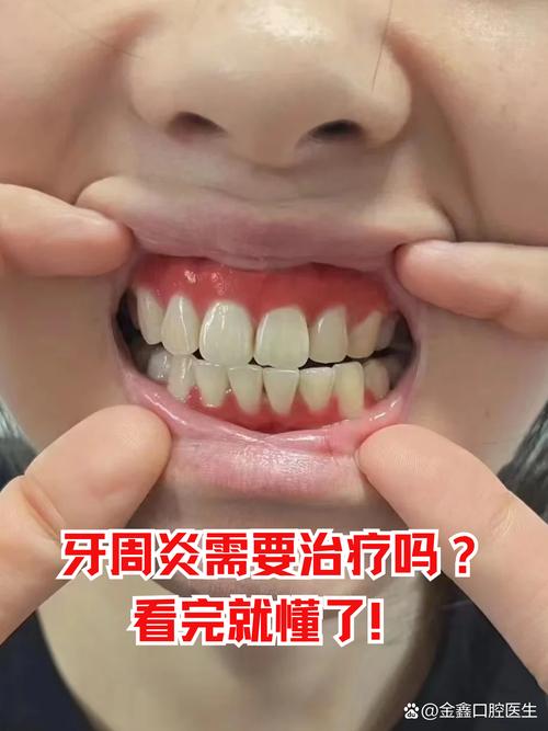 我有牙周炎能种牙吗-图1 我有牙周炎能种牙吗-图1
