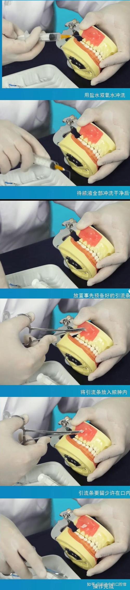 牙槽骨前突手术方法-图3 牙槽骨前突手术方法-图3