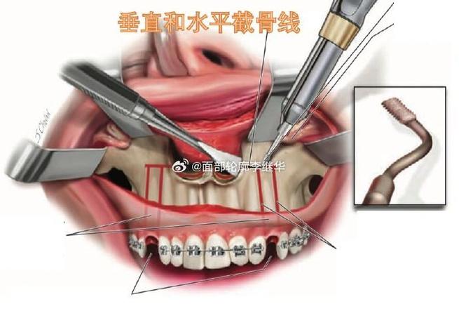 牙槽骨前突手术方法-图1 牙槽骨前突手术方法-图1