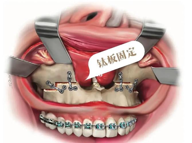 牙槽骨前突手术方法-图2 牙槽骨前突手术方法-图2