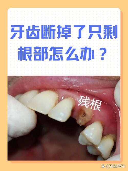 断牙修复方法有几种?各自适合哪种牙齿情况?-图2 断牙修复方法有几种?各自适合哪种牙齿情况?-图2