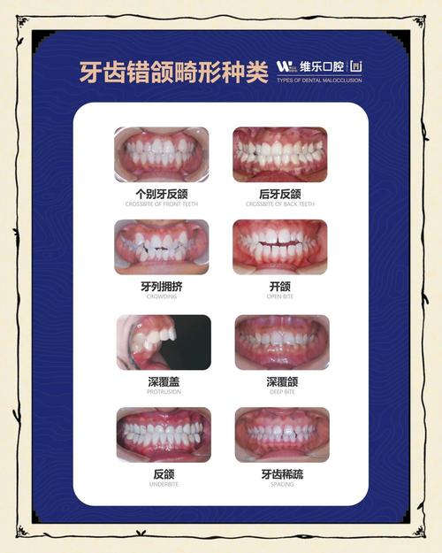 正畸骨性错颌的分类依据和类型有哪些?-图2 正畸骨性错颌的分类依据和类型有哪些?-图2
