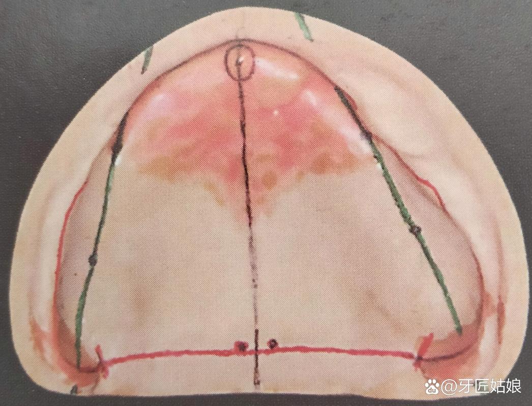 固定义齿填倒凹的方法有哪些具体操作步骤？-图3
