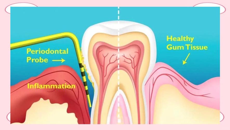 牙周纤维袋使用方法-图3