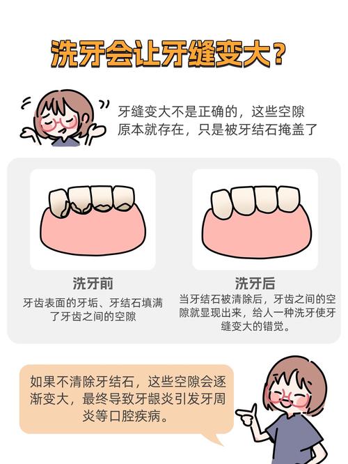 牙缝宽最好处理方法是什么?哪种方式更安全有效?-图2 牙缝宽最好处理方法是什么?哪种方式更安全有效?-图2