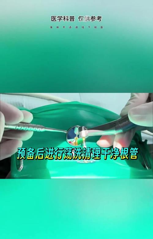 根管振荡仪使用方法-图2 根管振荡仪使用方法-图2