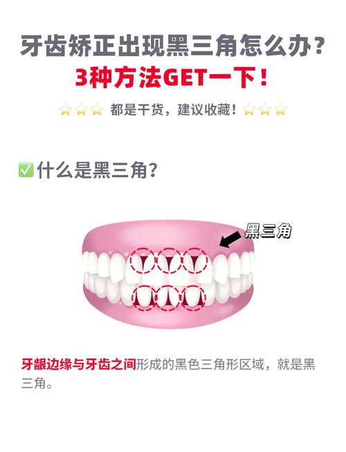 黑三角牙齿处理方法-图1 黑三角牙齿处理方法-图1