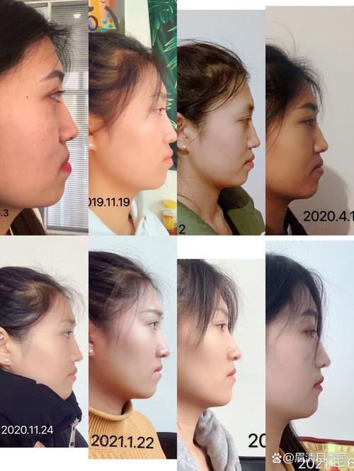 骨性地包天正畸后效果-图2 骨性地包天正畸后效果-图2