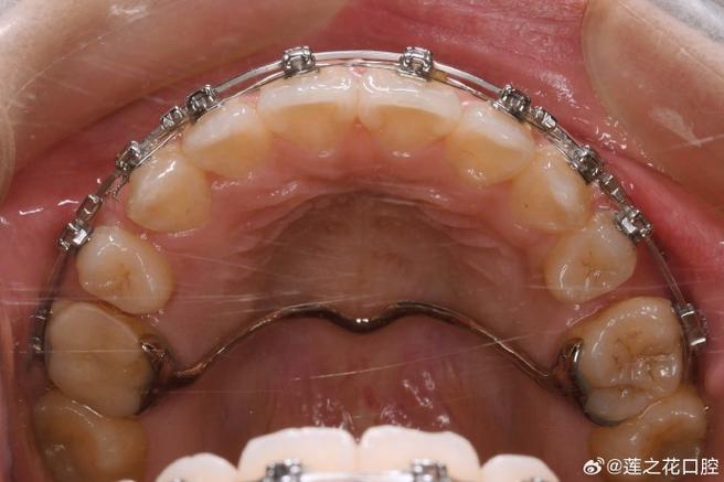 正畸横腭杆需要佩戴多久？时长因人而异吗？-图1
