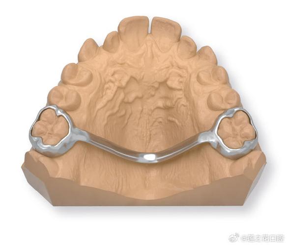 正畸横腭杆需要佩戴多久?时长因人而异吗?-图3 正畸横腭杆需要佩戴多久?时长因人而异吗?-图3