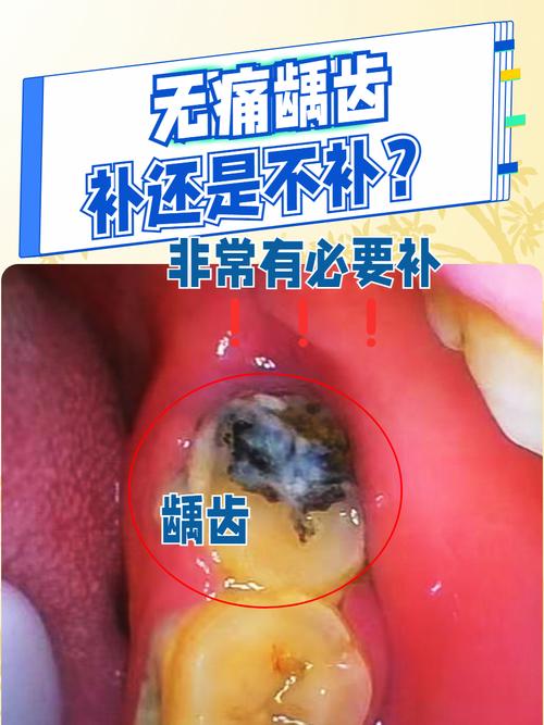 蛀牙对种牙有影响吗-图1 蛀牙对种牙有影响吗-图1