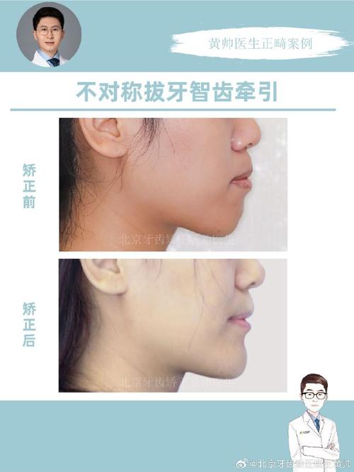 49岁想做牙齿正畸，这个年龄矫正还来得及吗？-图2