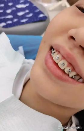 49岁想做牙齿正畸，这个年龄矫正还来得及吗？-图3