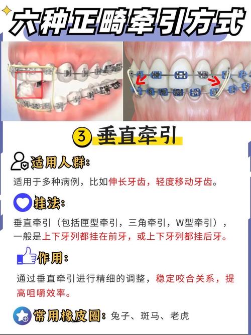 正畸牵引钩弯制方法-图1 正畸牵引钩弯制方法-图1