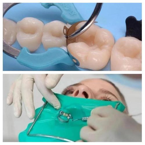 橡皮障使用方法视频-图2