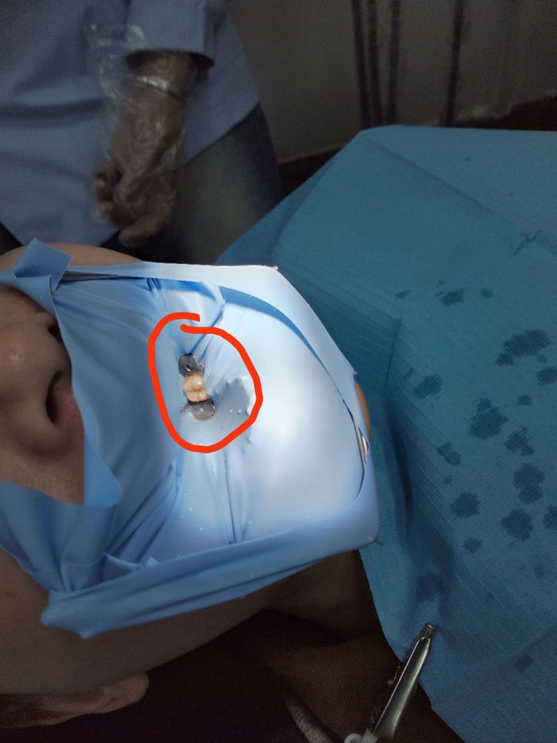 橡皮障使用方法视频-图3 橡皮障使用方法视频-图3