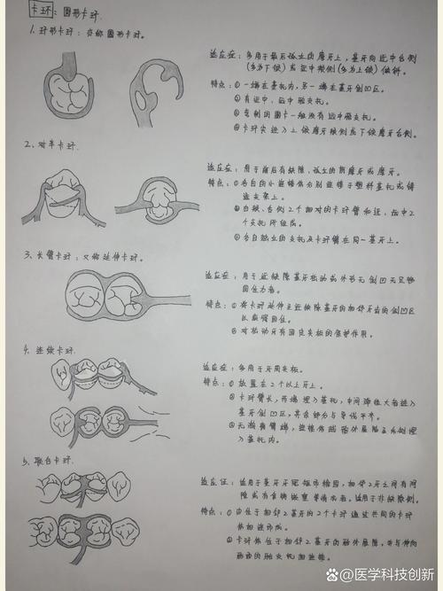 口腔科弯制卡环方法的关键步骤有哪些？-图1