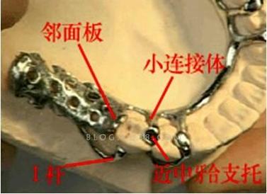 口腔科弯制卡环方法的关键步骤有哪些?-图3 口腔科弯制卡环方法的关键步骤有哪些?-图3