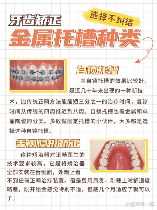 正畸自锁托槽诞生年份-图1