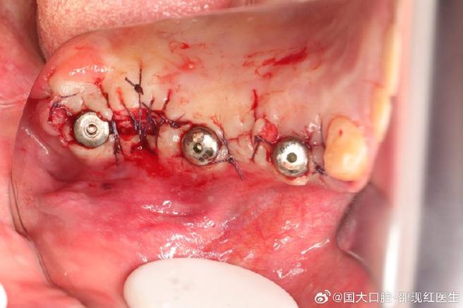 种牙手术后吃东西痛是什么原因？如何缓解？-图3