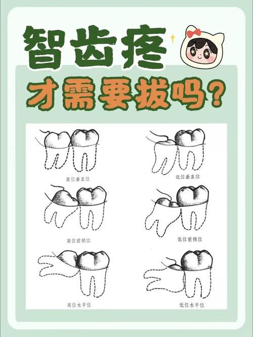 正畸一定要拔智齿吗？-图2