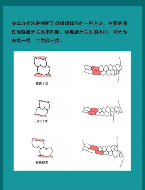 口腔正畸远中牙合关系矫正的关键策略有哪些?-图1 口腔正畸远中牙合关系矫正的关键策略有哪些?-图1