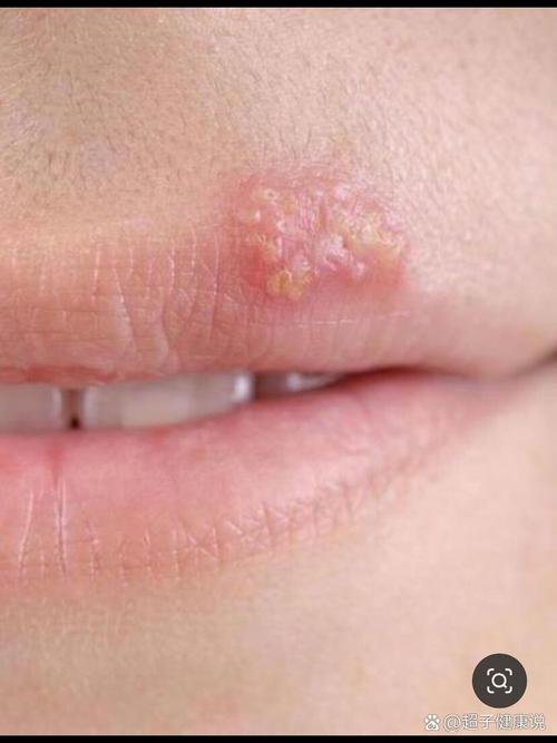 种完牙桩后嘴巴起泡-图3 种完牙桩后嘴巴起泡-图3