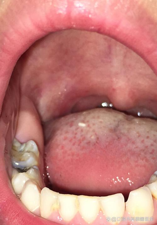 种完牙桩后嘴巴起泡-图2