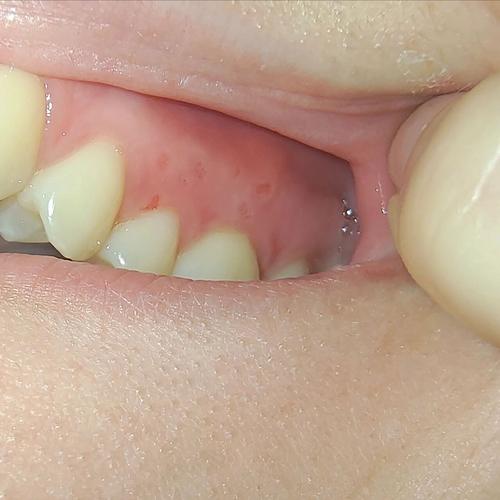 种完牙桩后嘴巴起泡-图1 种完牙桩后嘴巴起泡-图1