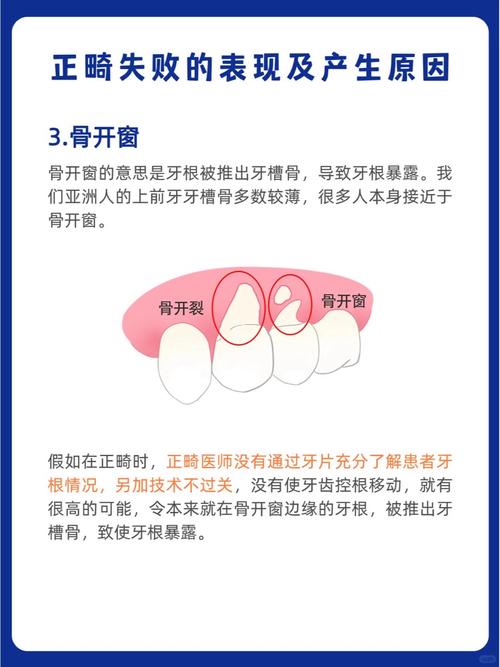 第一磨牙没了如何正畸-图1 第一磨牙没了如何正畸-图1