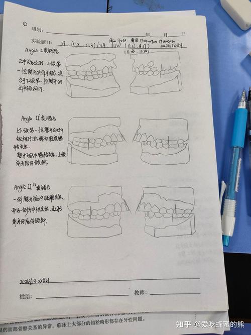 安式错颌的分类方法-图2