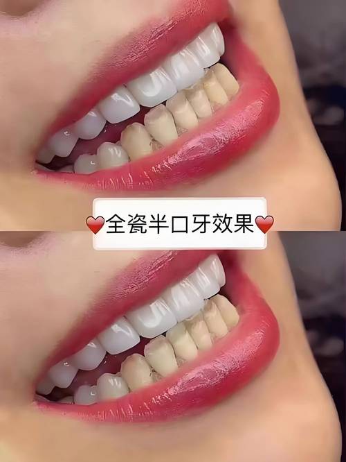 美国美白牙齿方法有哪些？主流方式有何不同？-图1