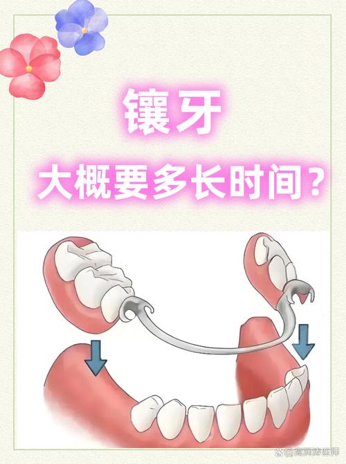 种牙几天后安装牙冠-图1 种牙几天后安装牙冠-图1