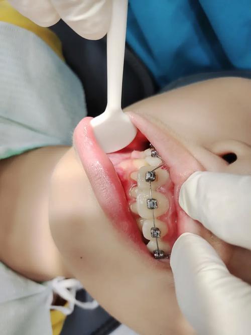 正畸自锁托槽粘接视频-图1 正畸自锁托槽粘接视频-图1