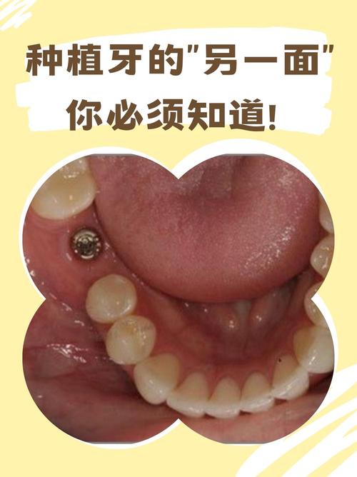 种牙后会出现哪些不良反应？这些症状需如何科学应对？-图3