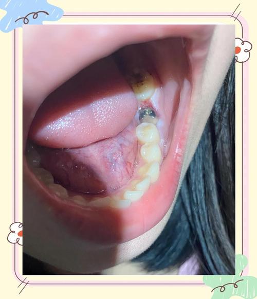 种牙后会出现哪些不良反应？这些症状需如何科学应对？-图2