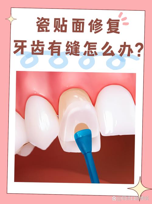 牙齿珐琅质修复方法-图1