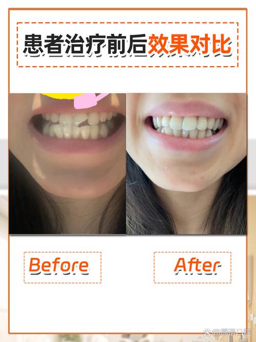 牙齿珐琅质修复方法-图3