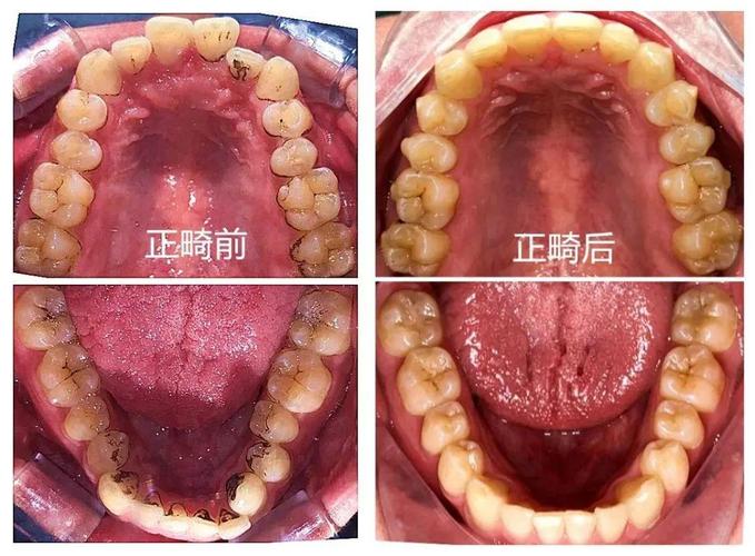 正畸下排牙齿向右倾斜是什么原因？-图3