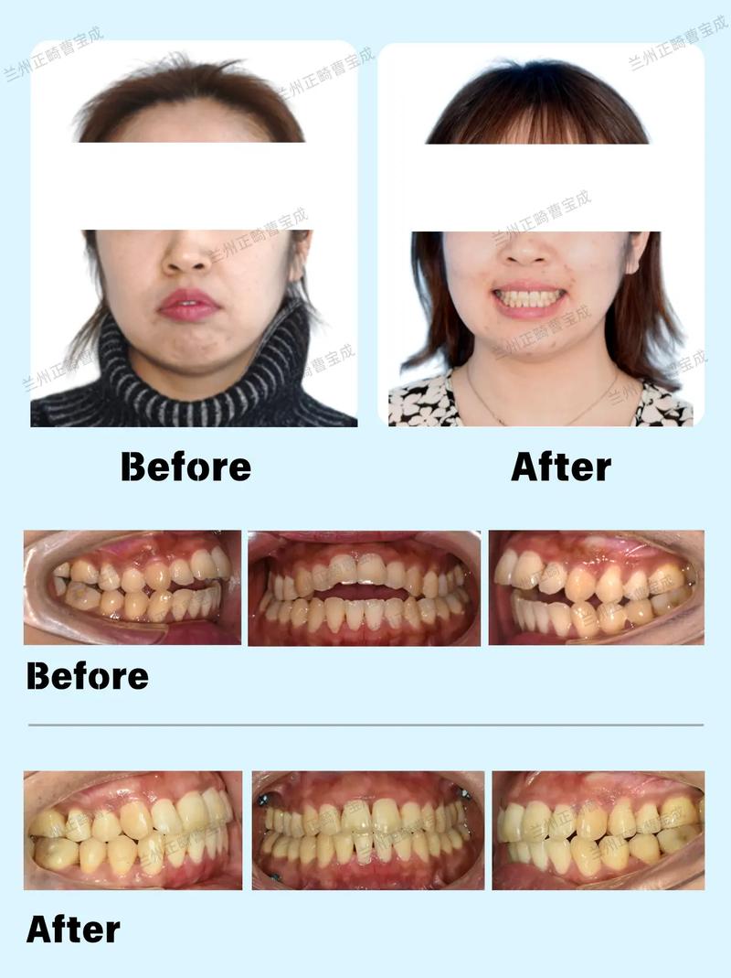开颌矫正，正畸与手术，哪种选择更优？-图1