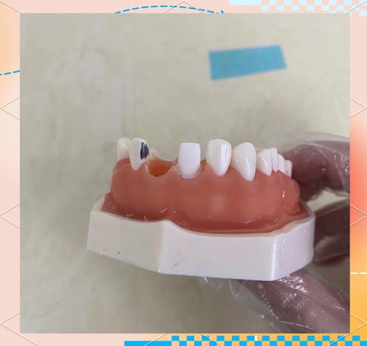 烤瓷牙预备的方法步骤具体有哪些操作要点？-图1