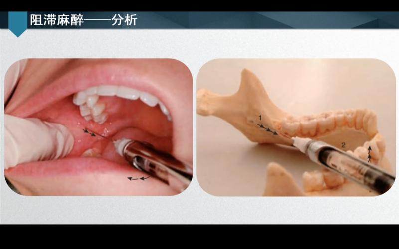 麻醉科无痛拔牙方法有哪些？核心技术是什么？-图2