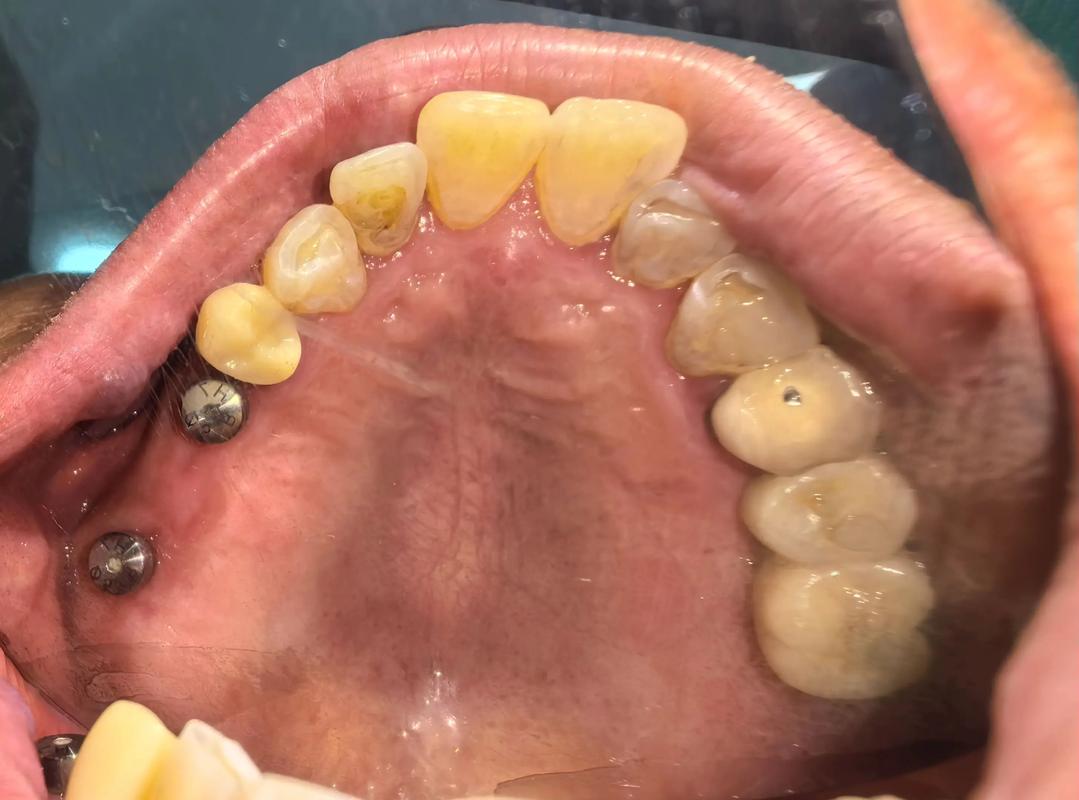 种牙后出现什么问题-图2