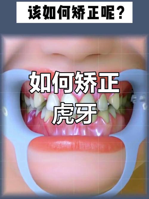 虎牙矫正方法有哪些？不同方法适合哪些情况？-图2