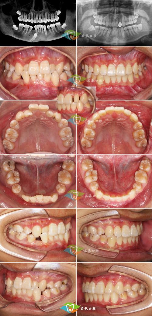 外国人都做牙齿正畸吗-图3 外国人都做牙齿正畸吗-图3