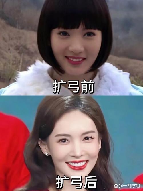 牙齿正畸扩弓真的能改变脸型吗？-图2