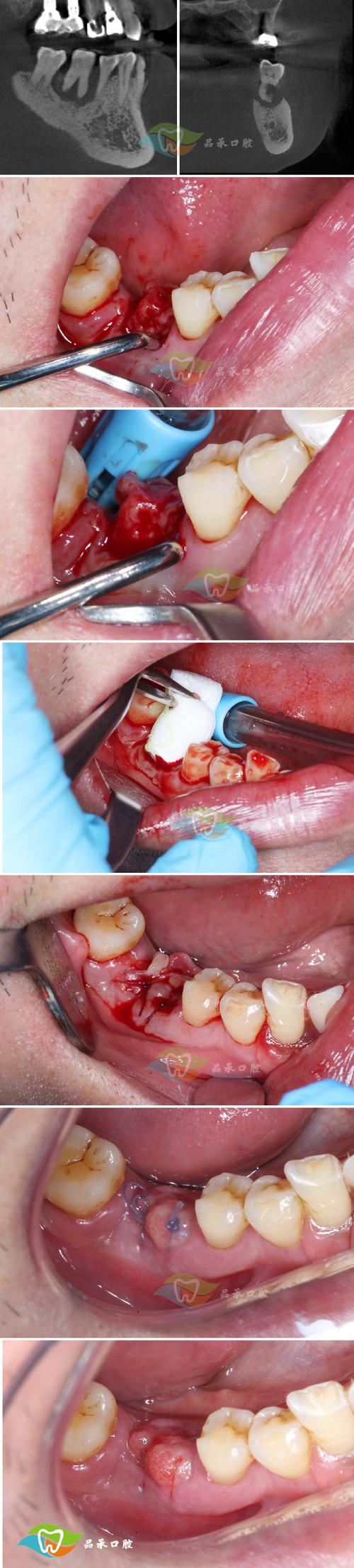 正畸骨皮质切开术视频，术式要点如何直观呈现？-图3